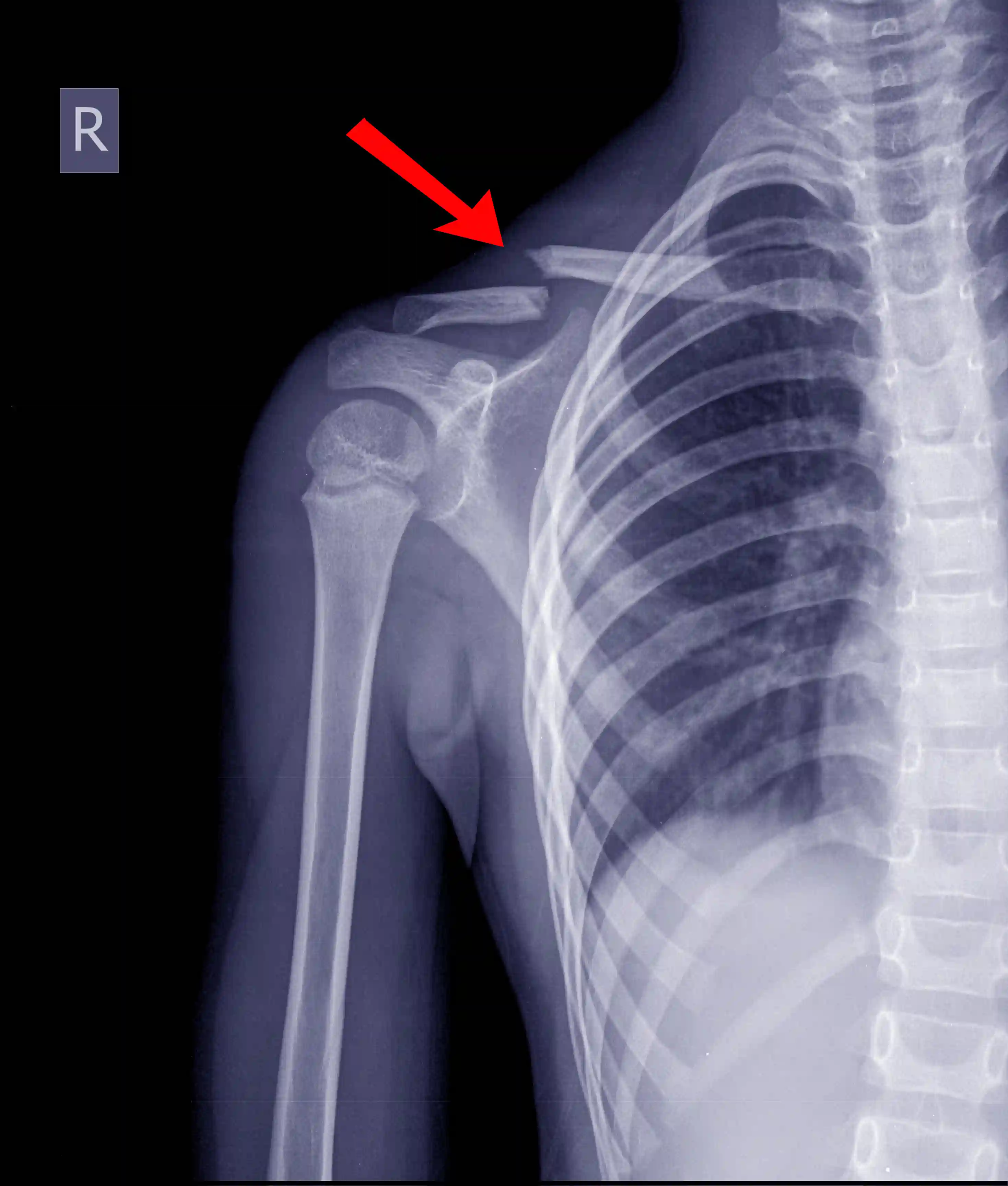 Shoulder Instability Surgery